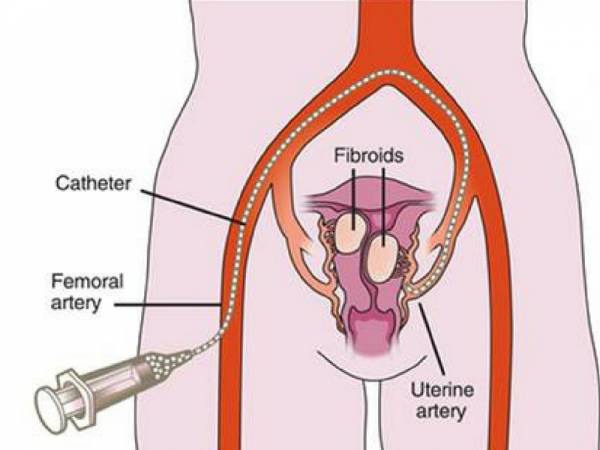 Usa Fibroid Centers