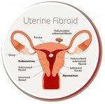 Usa Fibroid Centers - 4