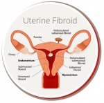 USA Fibroid Centers - 5